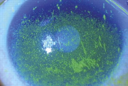 oeil sec