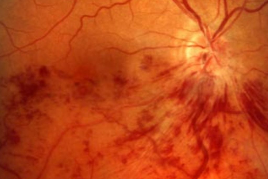 thrombose oculaire
